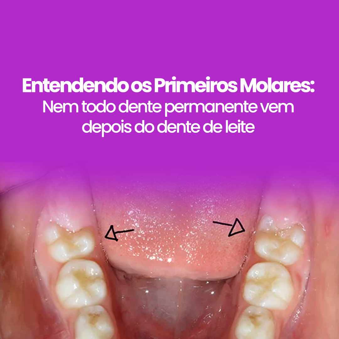 Entendendo os Primeiros Molares: Nem todo dente permanente vem depois do dente de leite